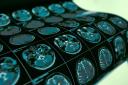 A doctor who was diagnosed with incurable brain cancer remains disease-free after a year following experimental treatment (Yuriy Klochan/Alamy)